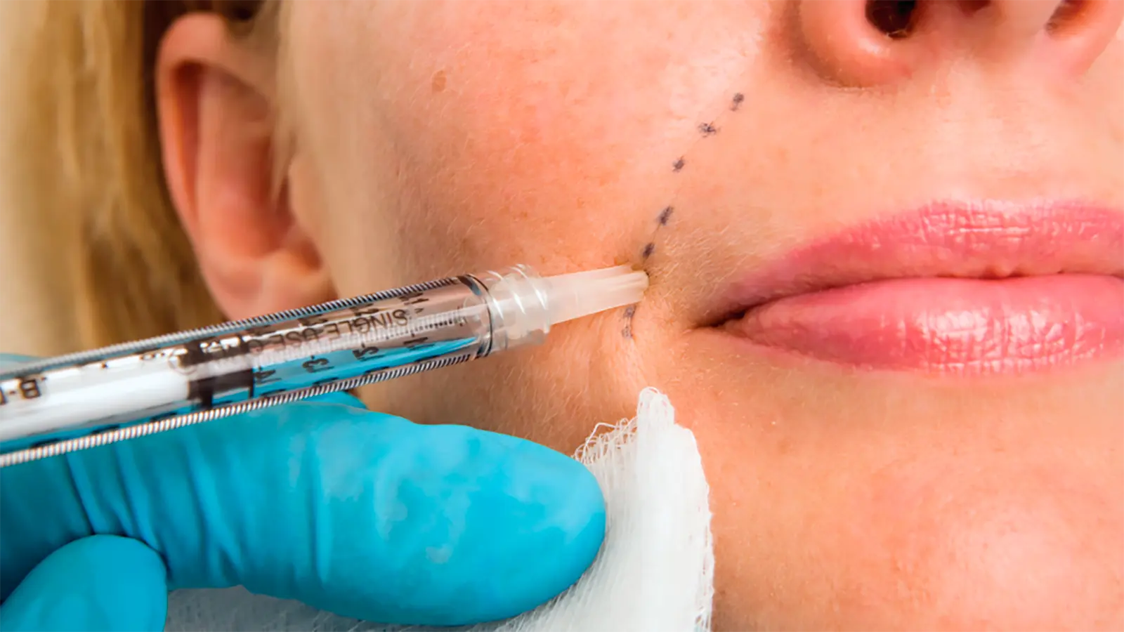 lose-up of a cosmetic provider administering an injectable treatment near a woman’s lips and lower face.